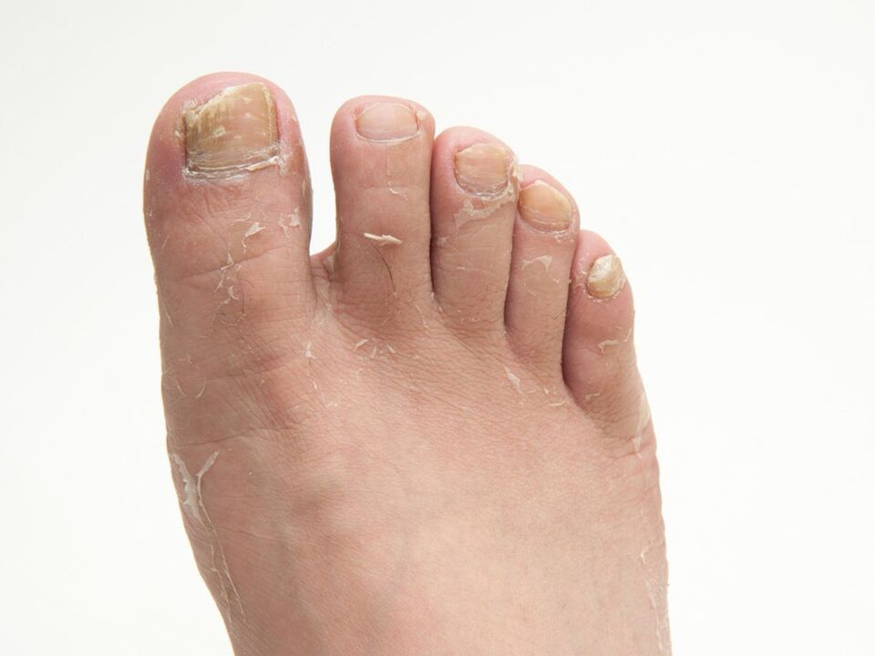 Champignon sur la peau des jambes et leur traitement avec de la crème zxcvbnmqwort