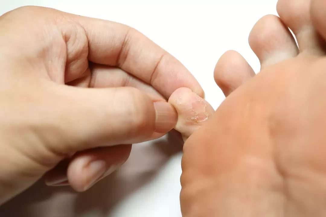 Champignon sur vos doigts et votre traitement avec de la crème démyxil