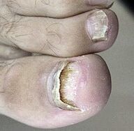 Le champignon des ongles a commencé