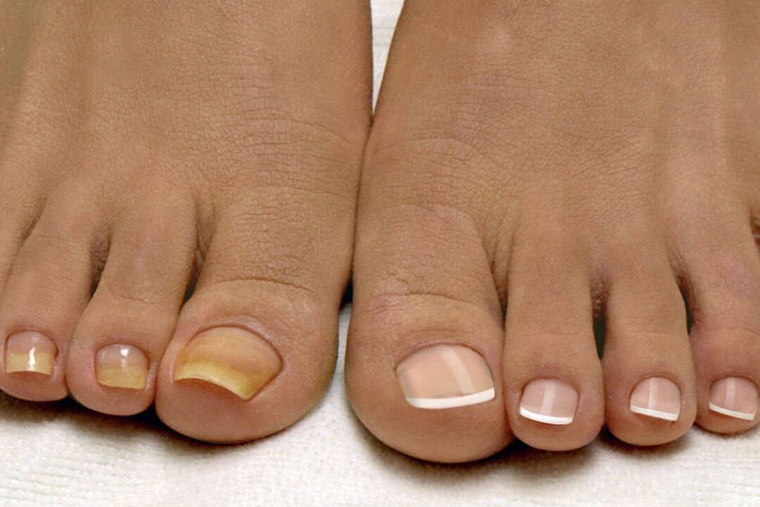 Des ongles sains de l'autre côté avec un champignon sur une jambe