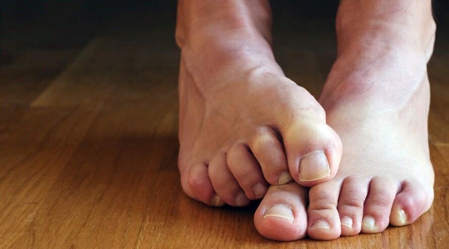 Symptômes des champignons de l'ongle