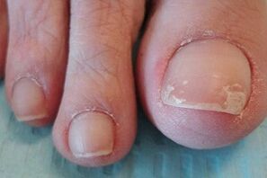 Dégâts des ongles avec une forme superficielle du champignon sur les jambes