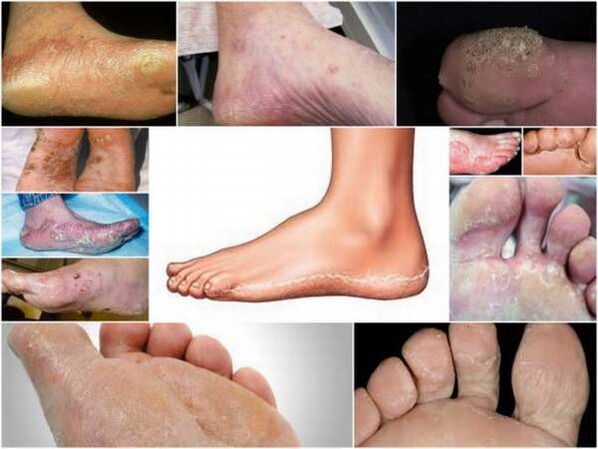 Carcinome épidermoïde-forme hyperkératosique de mycose des pieds