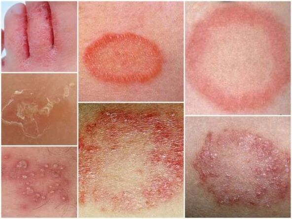 Trichophytose de la peau des jambes