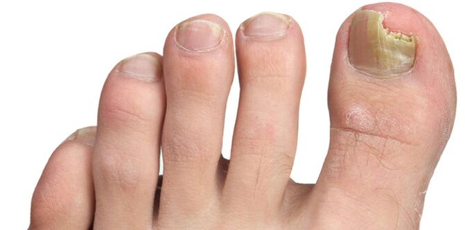 Infection fongique de la plaque à ongles